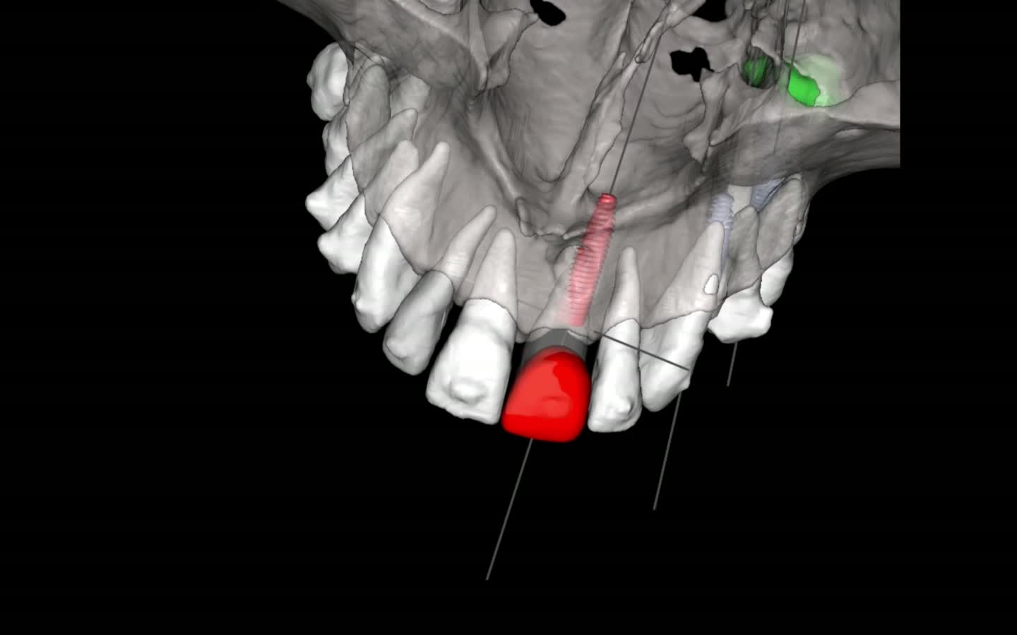Planejamento 3D real em tomografia: o dente a ser reposto destacado em vermelho, com a trajetória do implante — caso do Dr. Fernando Giovanella