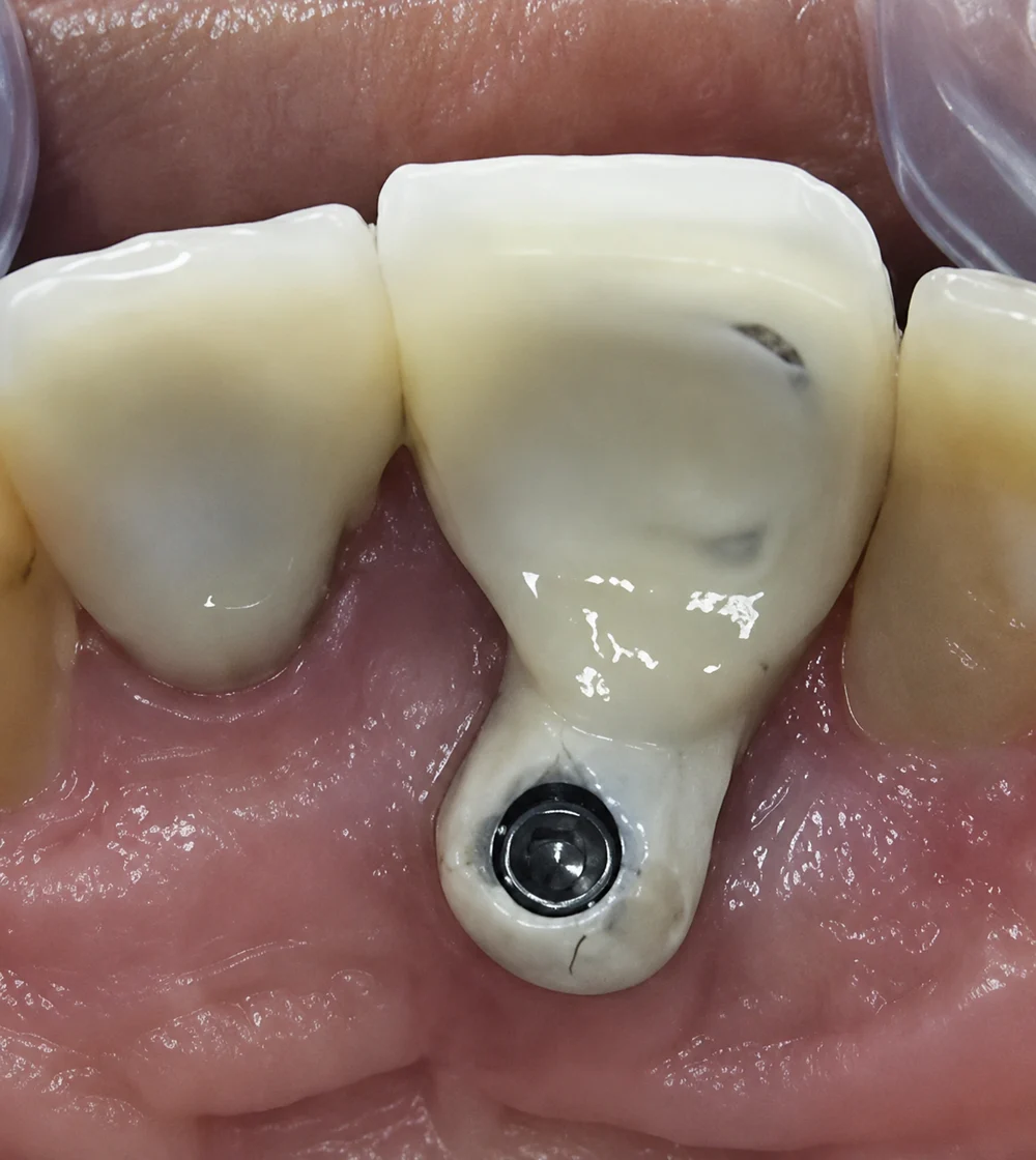 Coroa sobre implante mal posicionado: o orifício do parafuso emerge pela frente do dente
