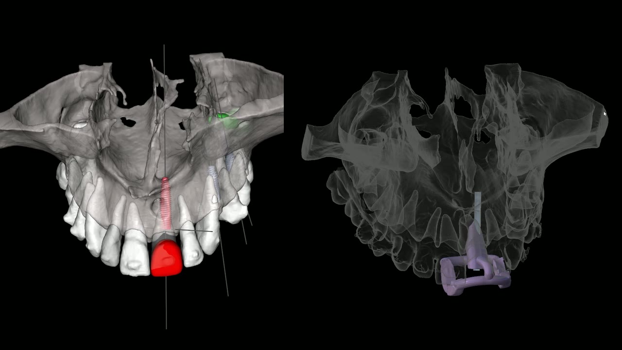 Planejamento 3D real: o dente unitário a ser reposto destacado em vermelho, com a trajetória do implante