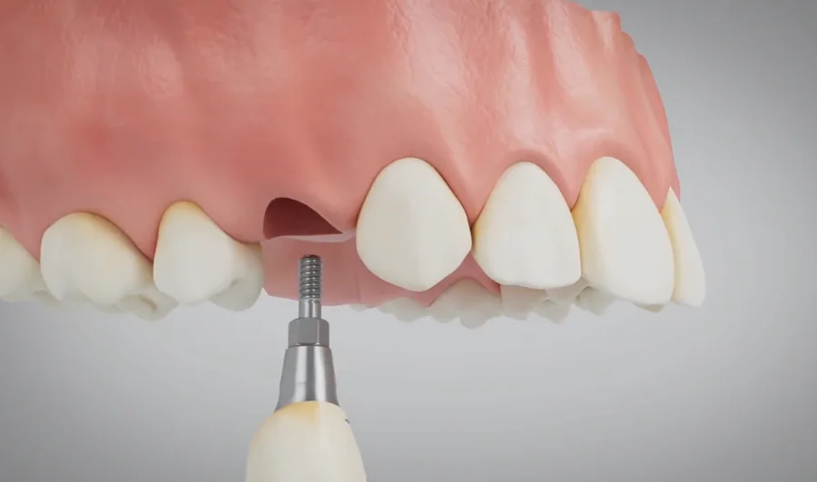 A coroa do implante sendo posicionada no espaço do dente perdido